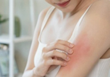 濕疹用藥正確擦 止癢不傷膚
