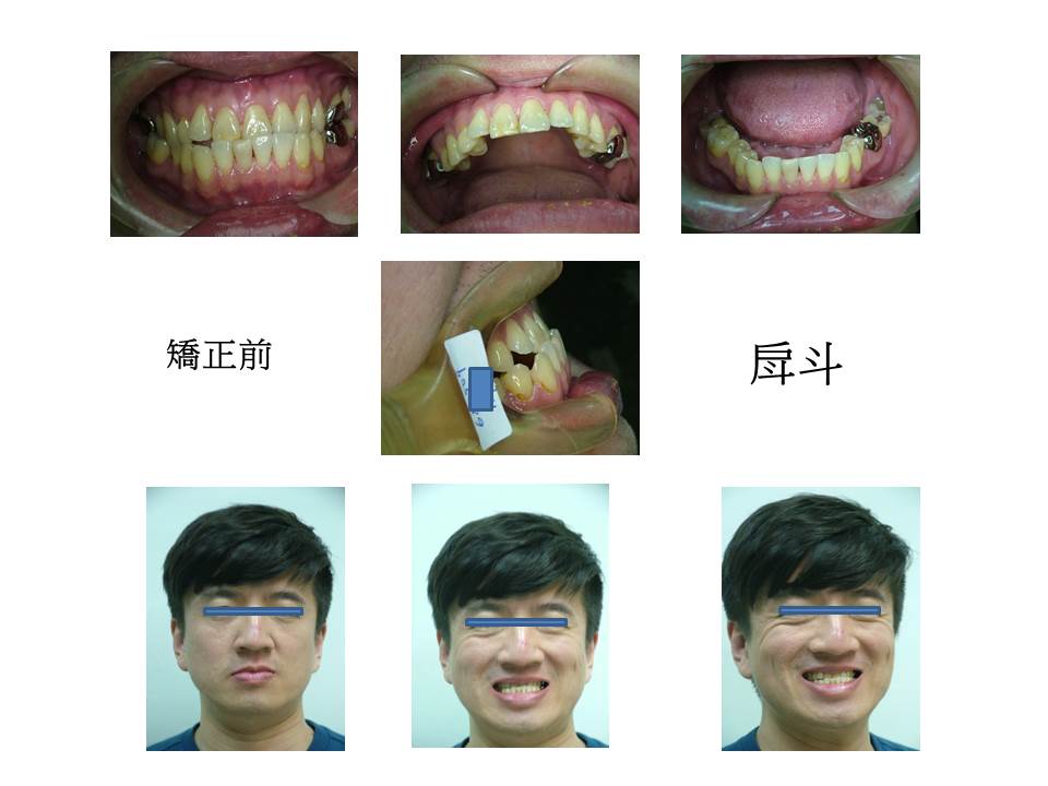 隱藏式舌側矯正 診療項目 巧聖牙醫