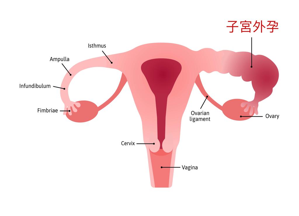 胚胎植入後子宮外孕的風險及MTX藥物治療