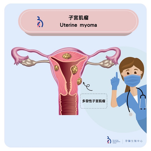 子宮肌瘤與懷孕🤰🏻