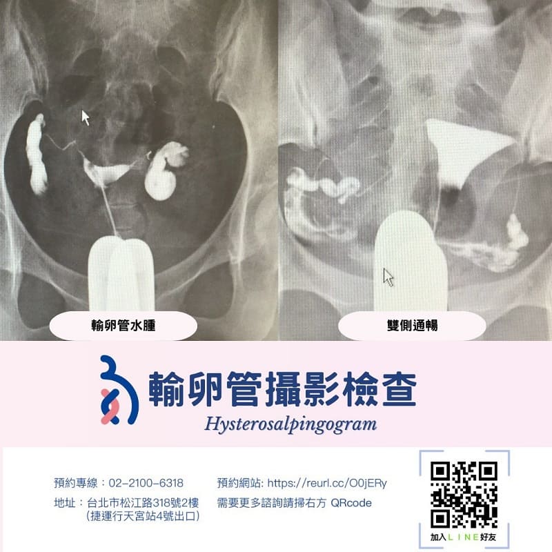 輸卵管攝影檢查 🧐是什麼？