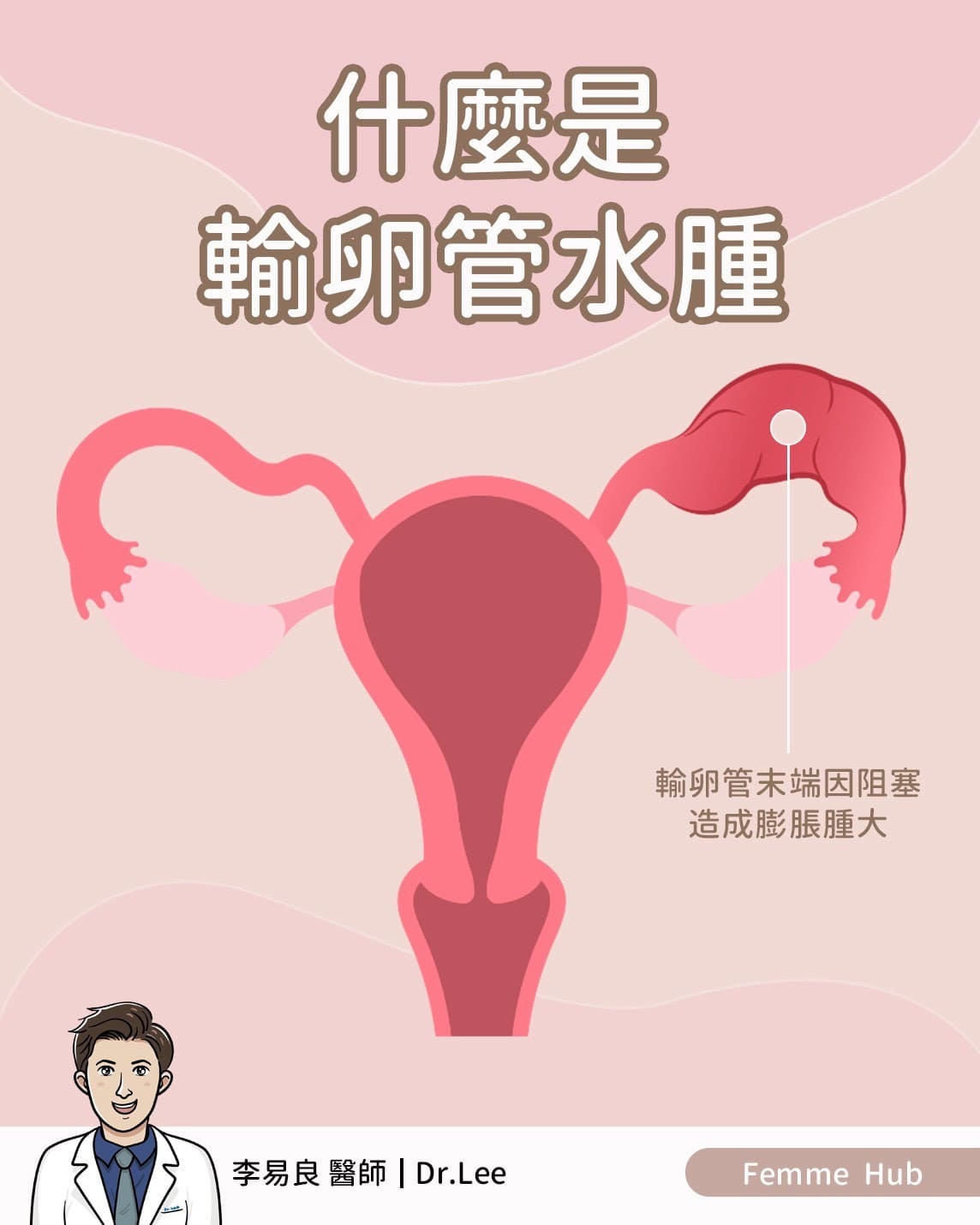 👨🏻‍⚕什麼是輸卵管水腫（Hydrosalpinx）？ 『 上篇 』