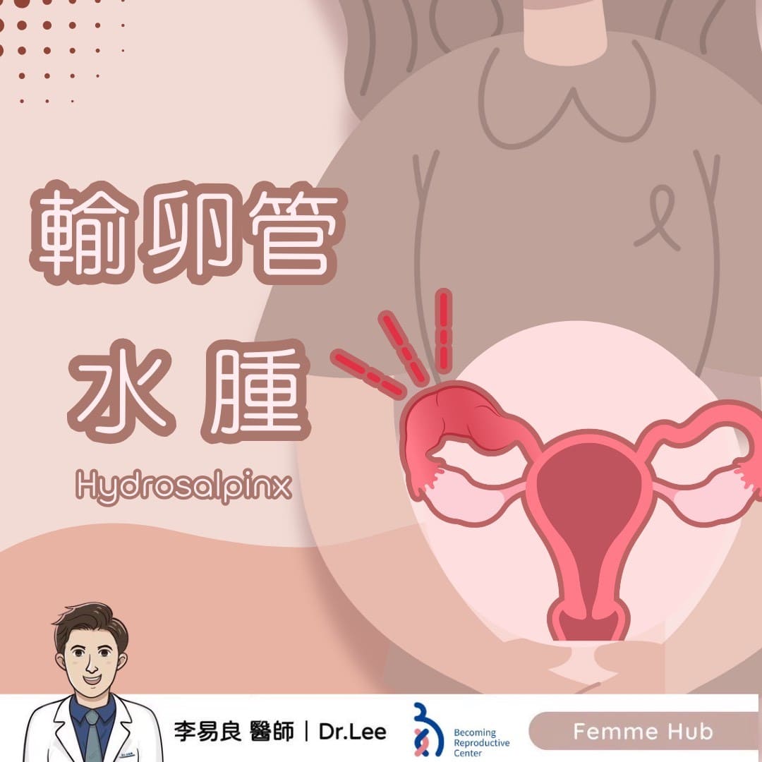 👨🏻‍⚕什麼是輸卵管水腫（Hydrosalpinx）？ 『 下篇 』