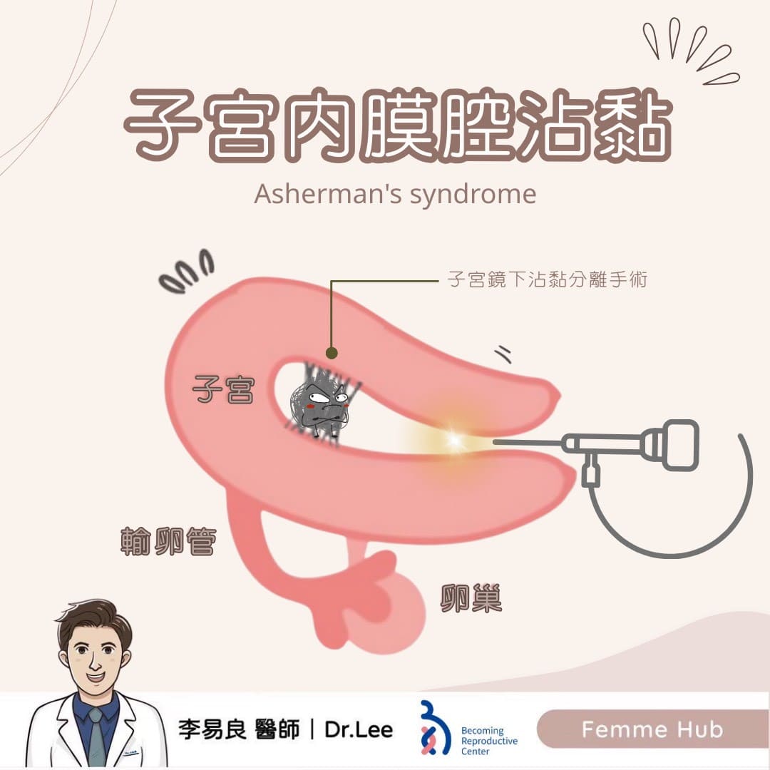 什麼是「子宮內膜腔沾黏」？