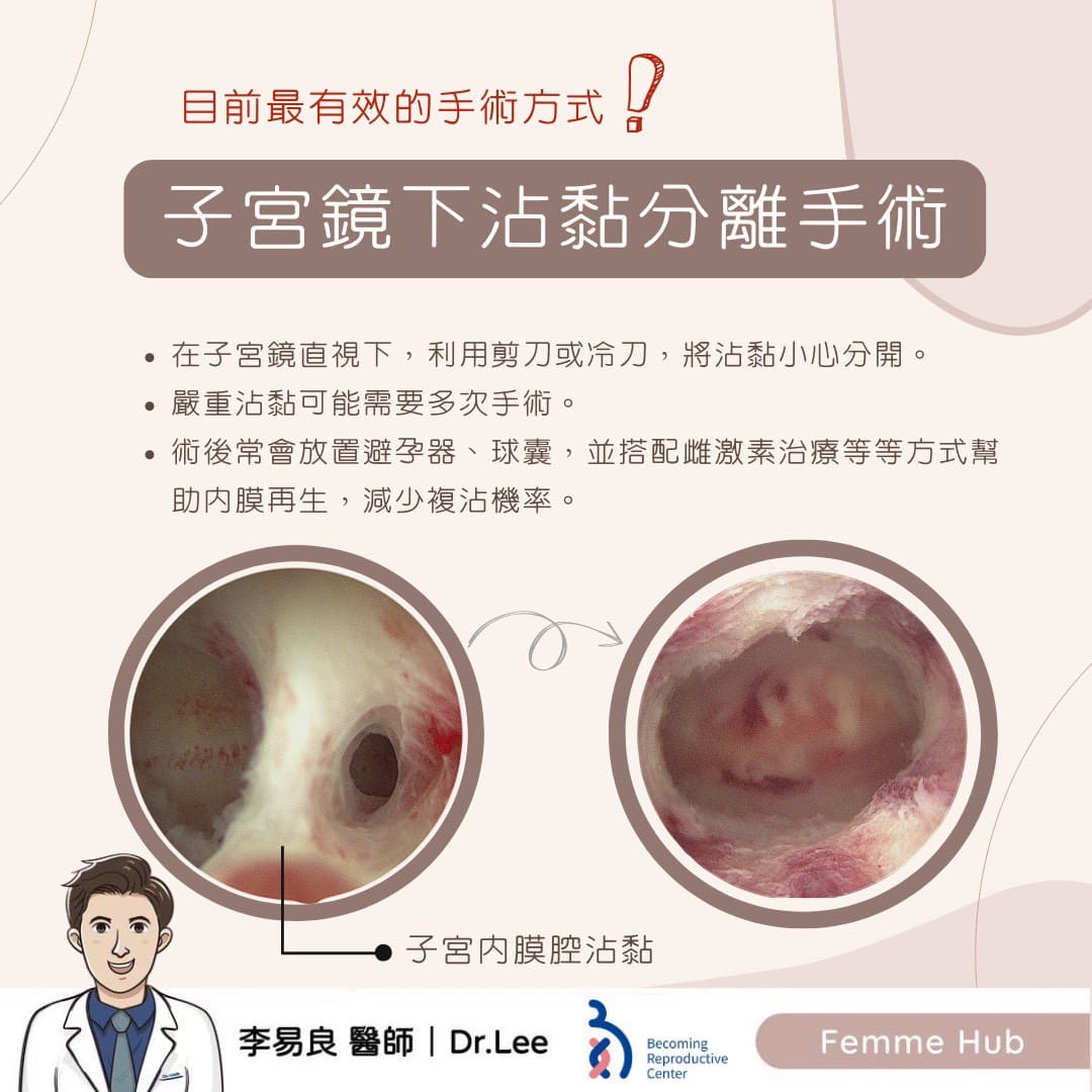 子宮內膜腔沾黏(下篇)