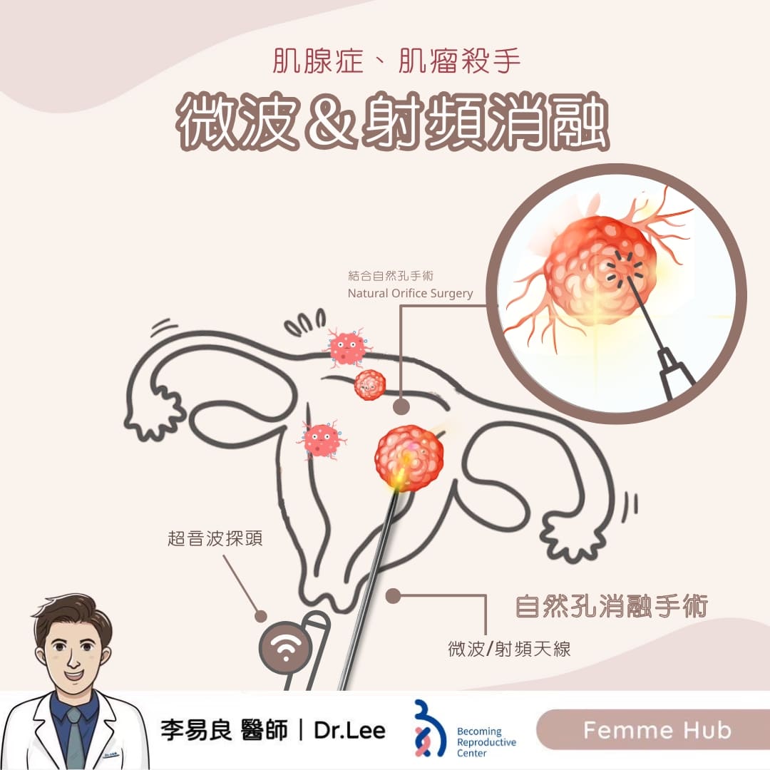 肌腺症及肌瘤殺手