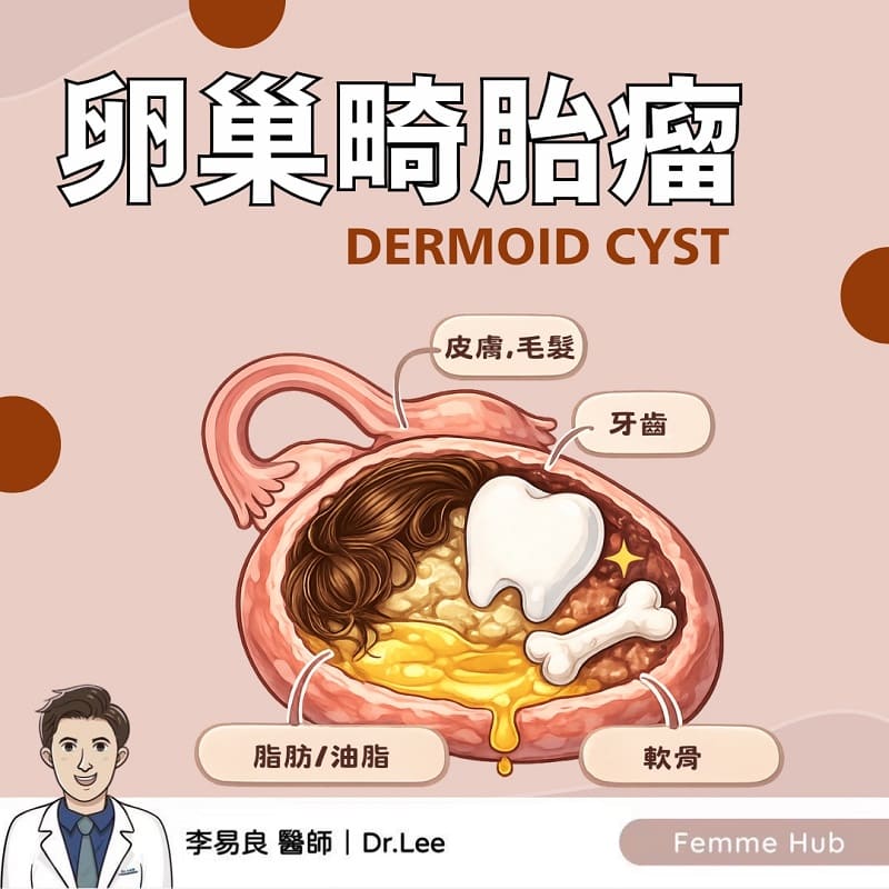 什麼是卵巢畸胎瘤?