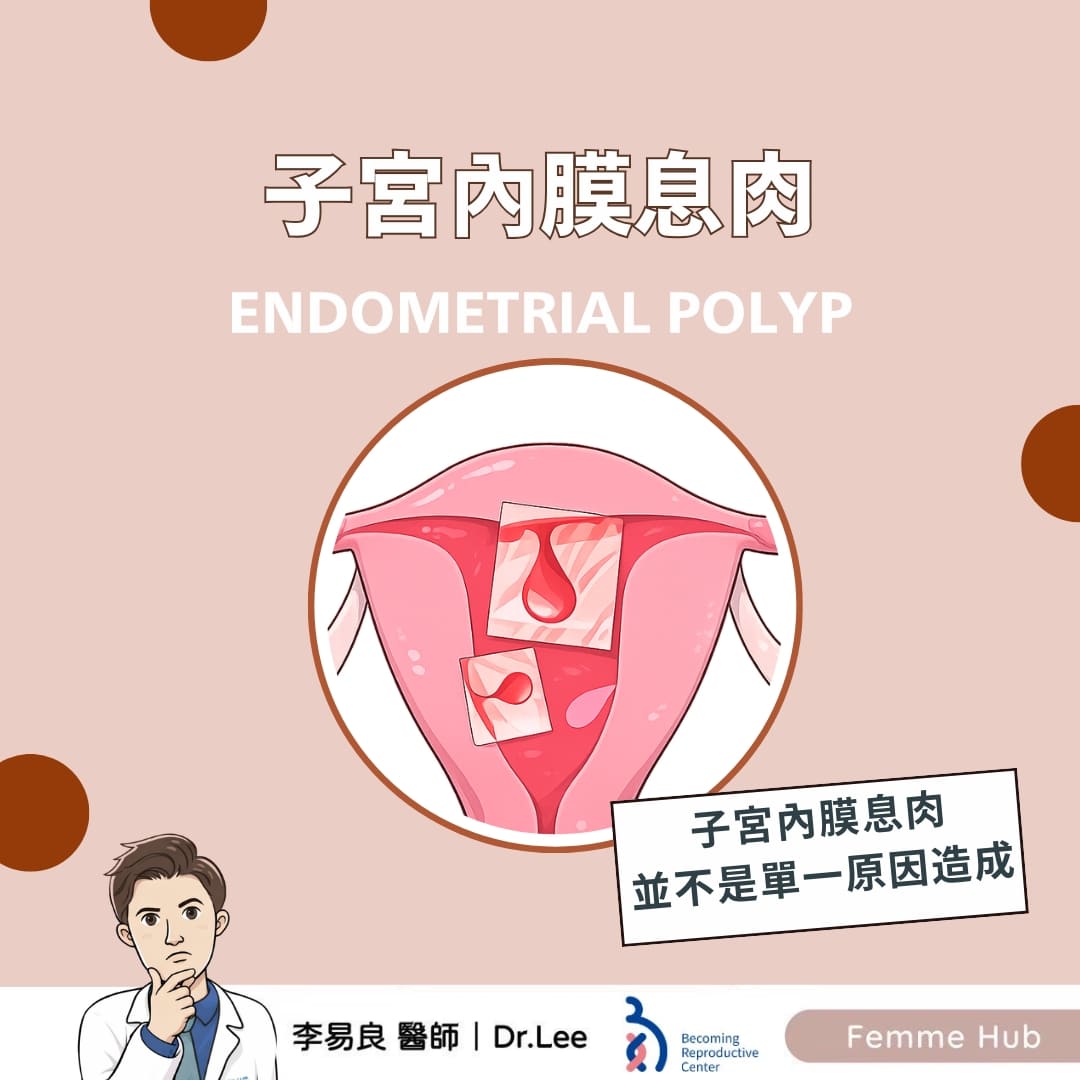 子宮內膜息肉：不只是雌激素的問題