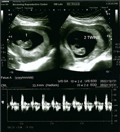 双胎妊娠🤰