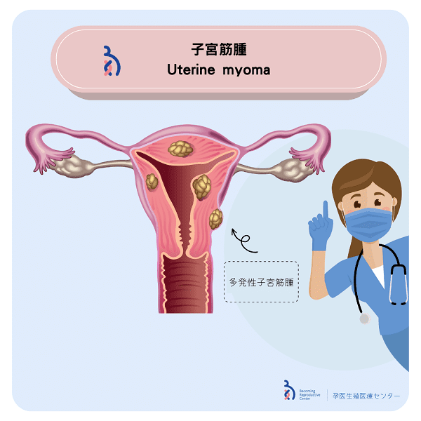 子宮筋腫と妊娠🤰🏻