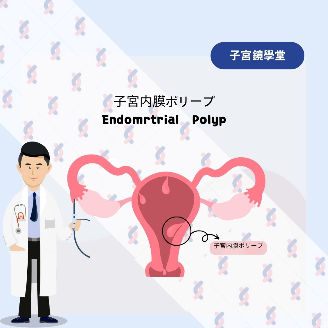 【子宮内ポリープとは何ですか？】