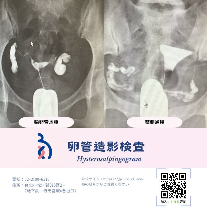 卵管造影検査 🧐って何？
