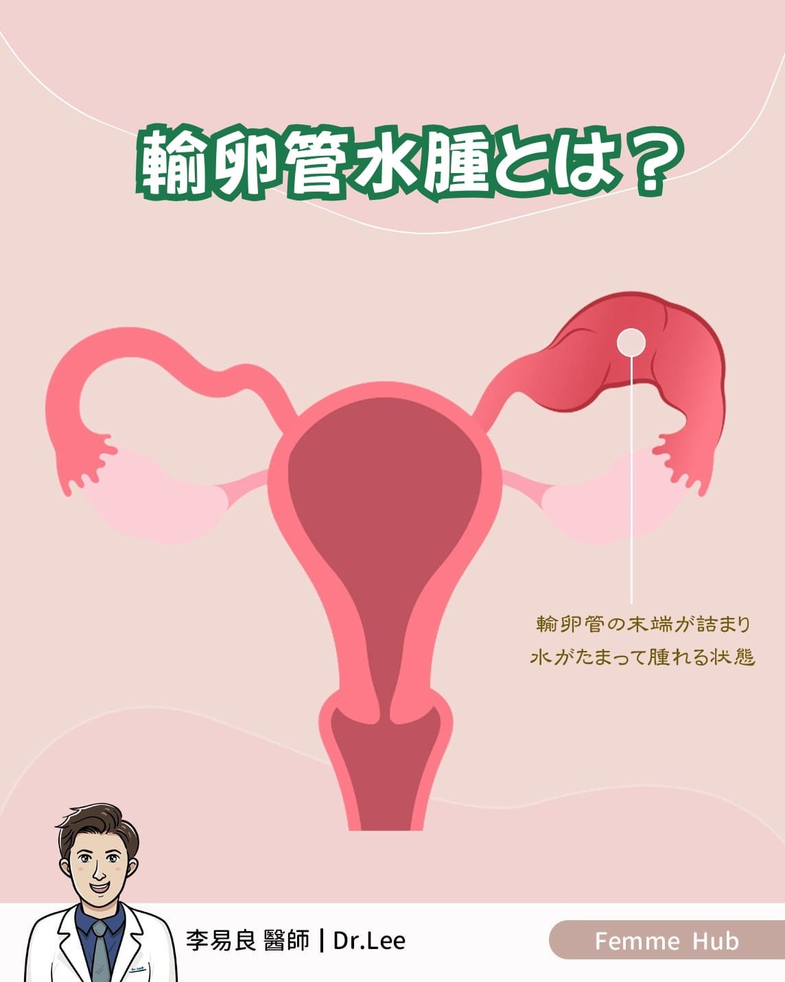 👨🏻‍⚕輸卵管水腫（Hydrosalpinx）とは？【上編】