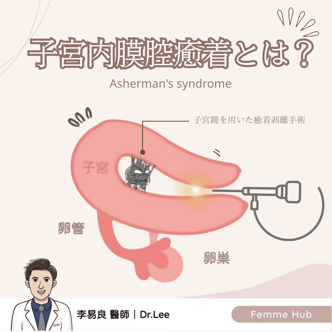 「子宮内腔癒着」とは？