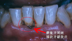 嚴重牙周病，導致牙齦發黃