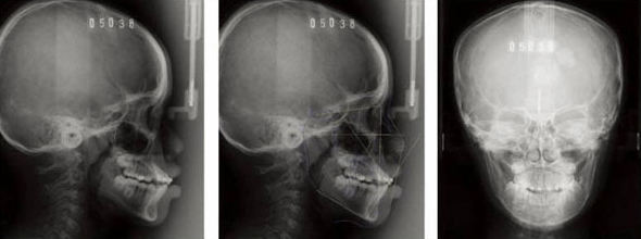 超大側頭顱影像、即時拍、即時影像、正頭顱全口影像