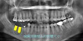 植牙前診斷：植牙前醫師會先幫病患拍攝x 片，方便檢視缺牙與骨頭狀態，先在電腦上模擬適合植入的植體尺寸與位置。