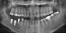 決定植牙位置與人工牙根的數目後，醫師便會將人工牙根植入缺牙區。