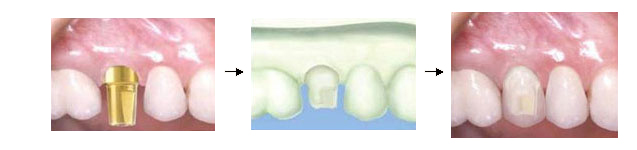 當牙肉成形時即可接上假牙基座，取模製作假牙將製作好的假牙裝回口內即可恢復咀嚼功能，整個植牙治療才算完成。
