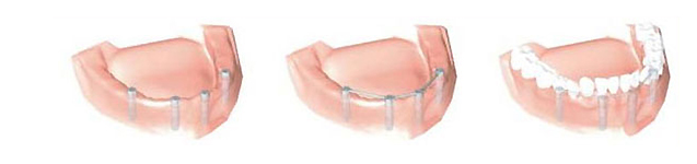 當牙肉成形時即可接上假牙基座，取模製作假牙將製作好的假牙裝回口內即可恢復咀嚼功能，整個植牙治療才算完成。