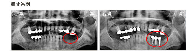 案例1-植牙前-左下缺牙/植牙後-左下區域已重建