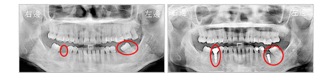 案例3-植牙前-左下、右下區域缺牙及左下第2大臼齒因前方牙位長期缺牙導致前傾/植牙後-缺牙區域植牙重建，左下缺牙區域並做局部矯正