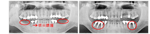 案例4-植牙前-左下、右下區域多顆缺牙及右下第2小臼齒根尖膿腫/植牙後-第2小臼齒拔除與缺牙區域一起重建