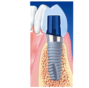 本診所採用的人工牙根為美國3i公司所特殊研發出之生物人工牙根