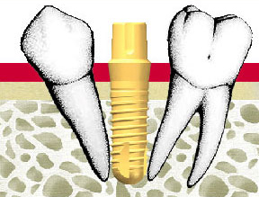 醫師會針對每位患者的牙周條件，選用最適合植入的植體