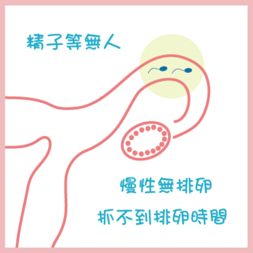 多囊性卵巢症候群PCOS：Polycystic Ovaries Syndrome示意圖