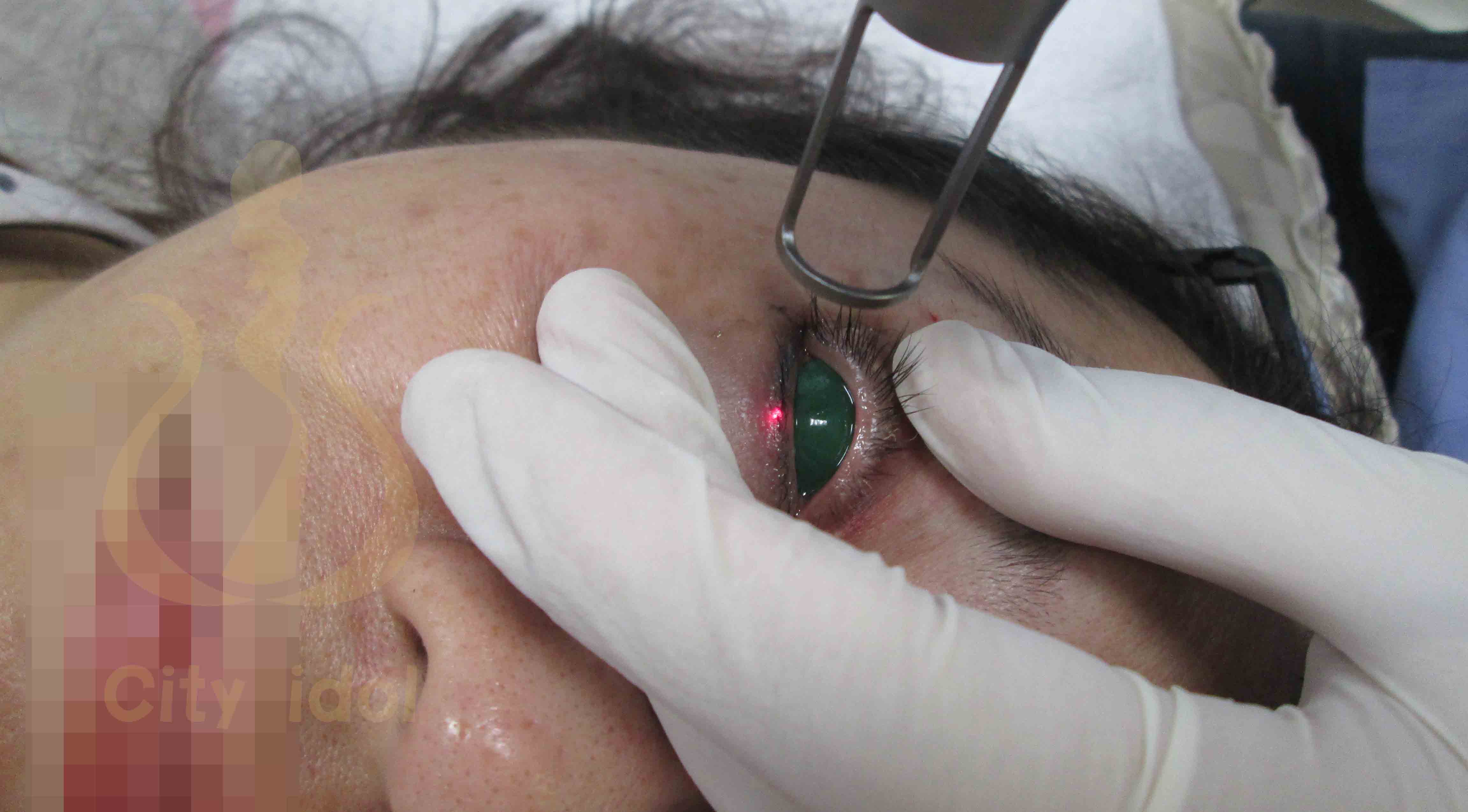 術 中 雷 射 除 上 眼 線 及 除 下 眼 線 ( 有 戴 綠 色 的 眼 球 保 護 片 )-2