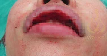 手 術 過 程 及 切 下 的 唇 部 組 織​​​​​​​