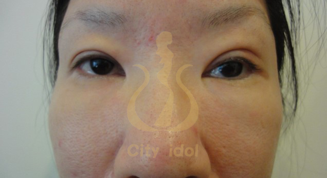 術 後 3 個 月 左 側 眼 皮 反 複 紅 腫 及 瞼 板 處 縫 線 外 露