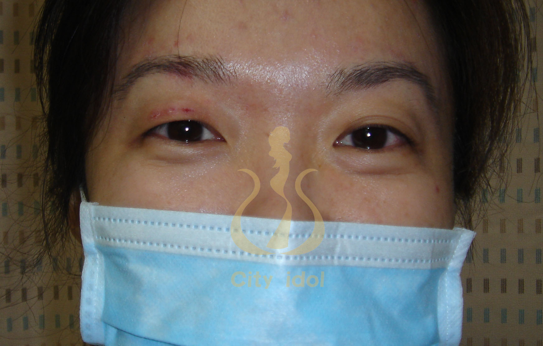 術 前 評 估 及 術 後 3 週 ( 拆 除 右 側 雙 眼 皮 後 1 週 )