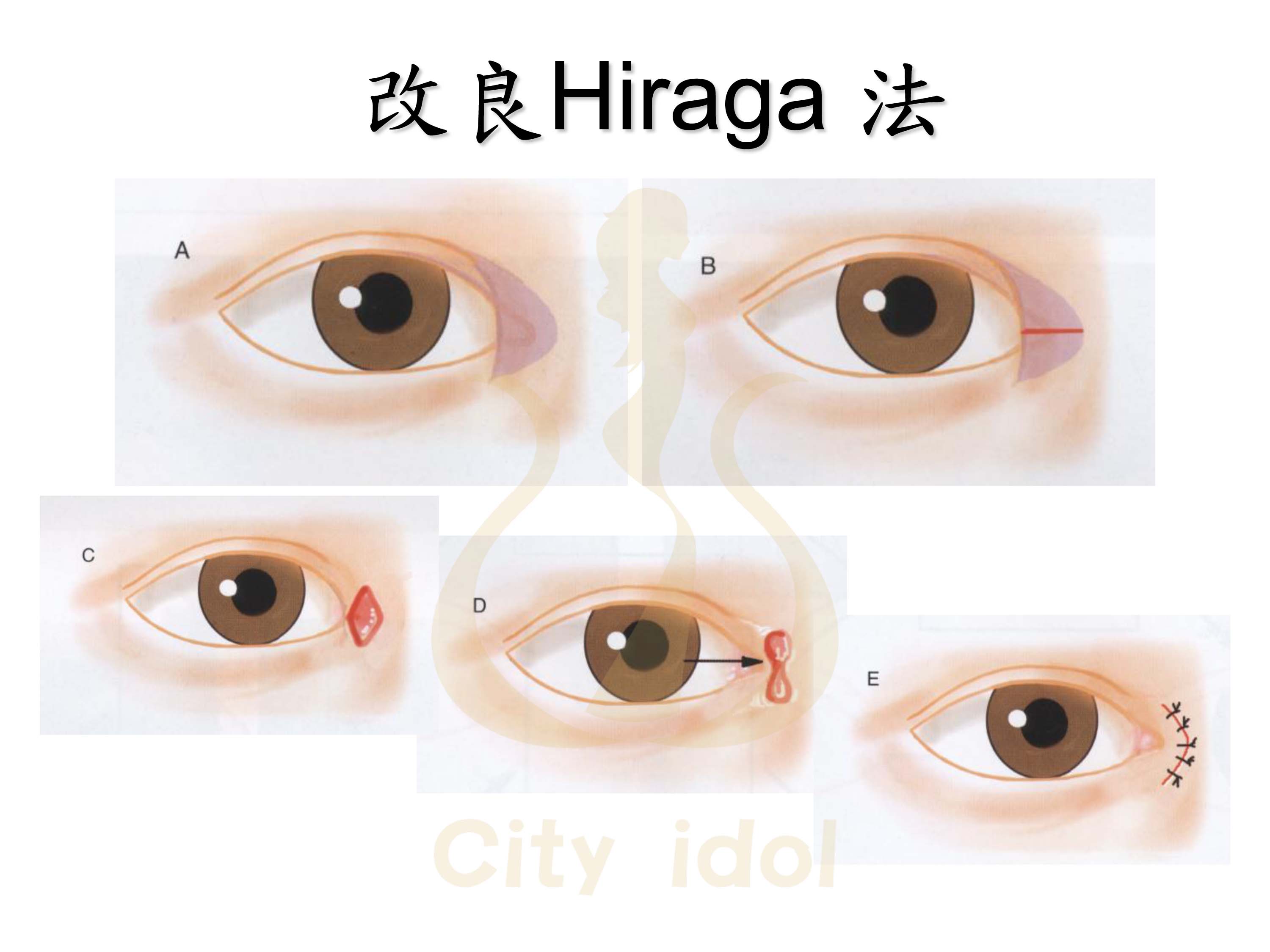 改良Hiraga法