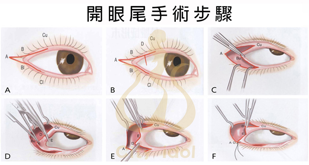 開眼尾手術步驟