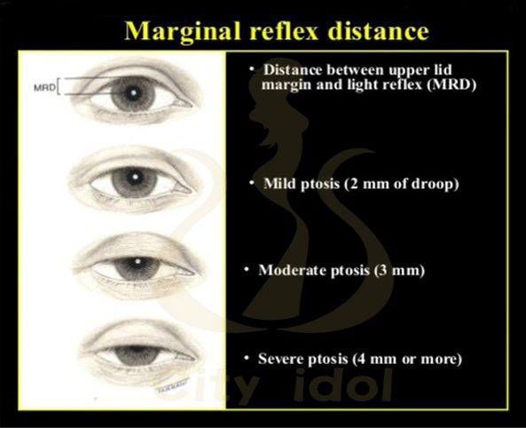 B. 眼 瞼 下 垂 嚴 重 程 度 分 類 - 2