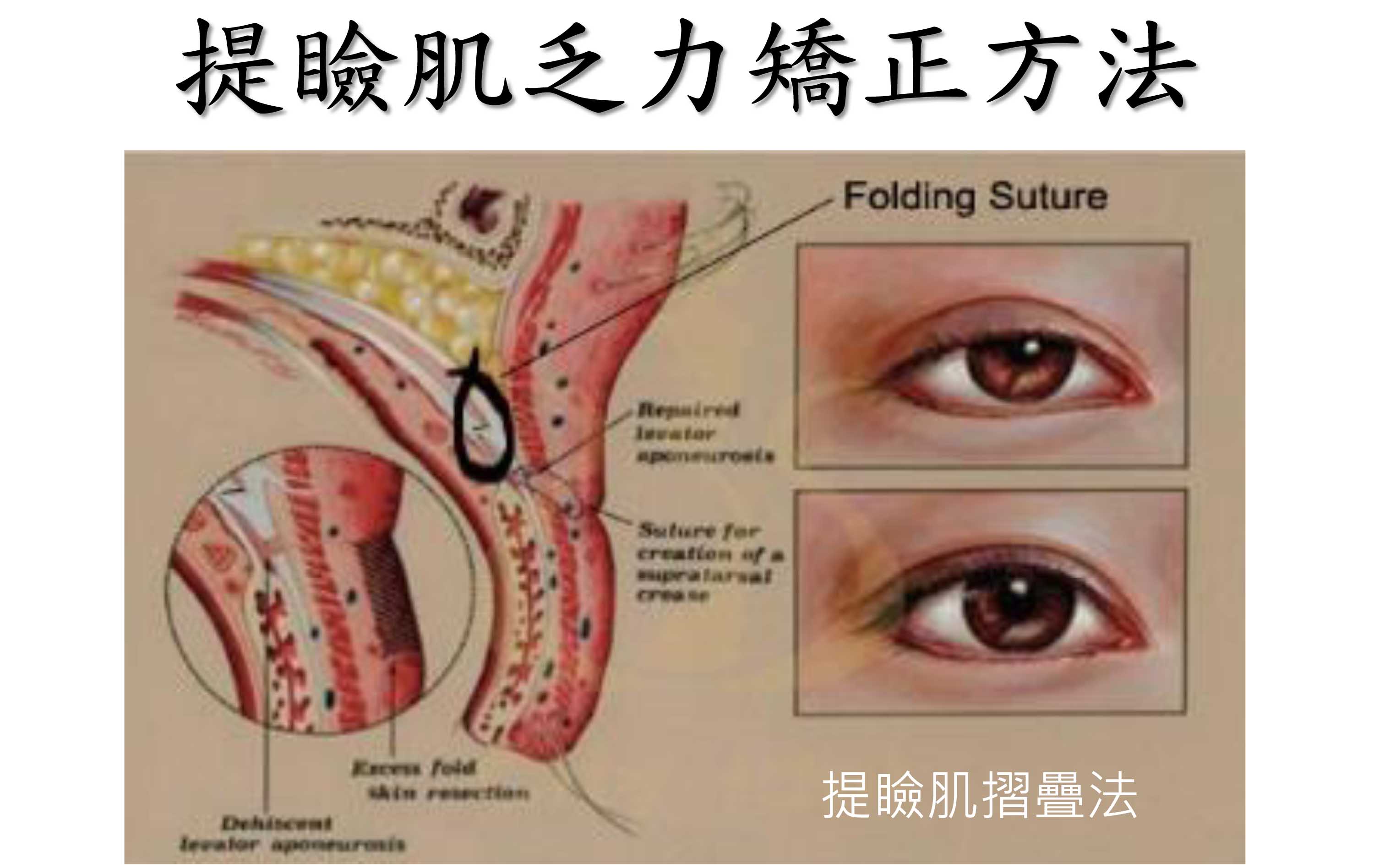 提 瞼 肌 摺 疊 法
