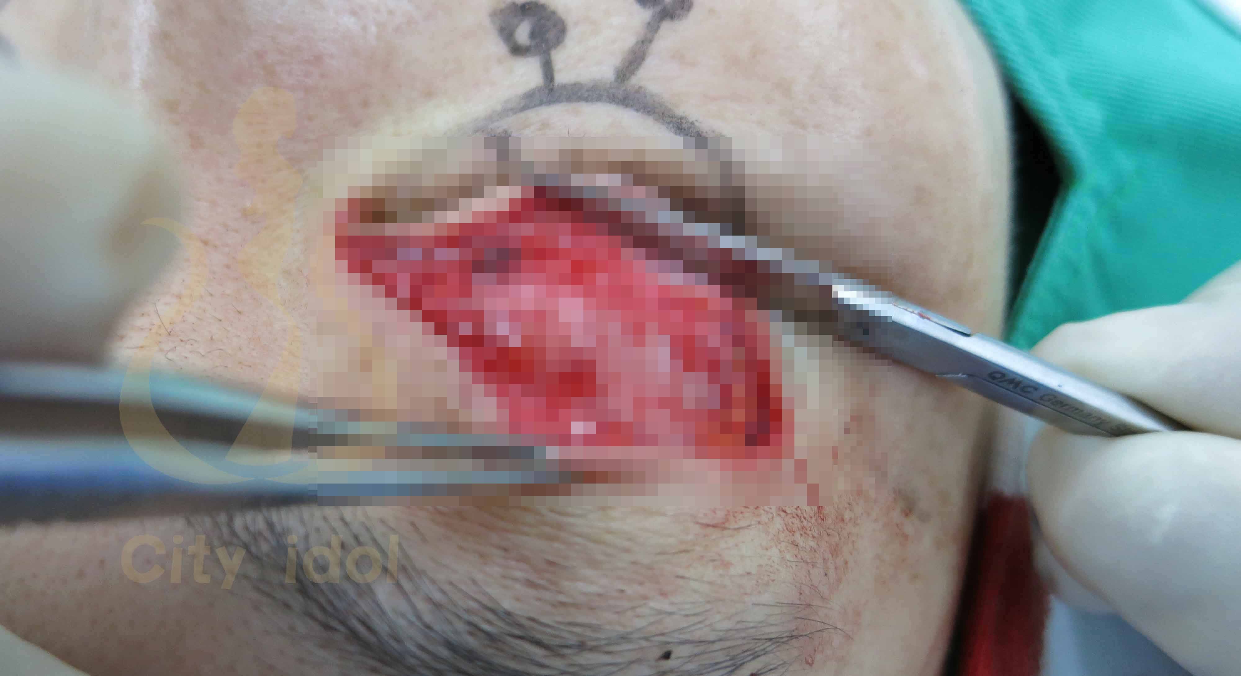 術 中 分 離 出 提 瞼 肌 及 施 行 提 臉 肌 摺 疊 手 術
