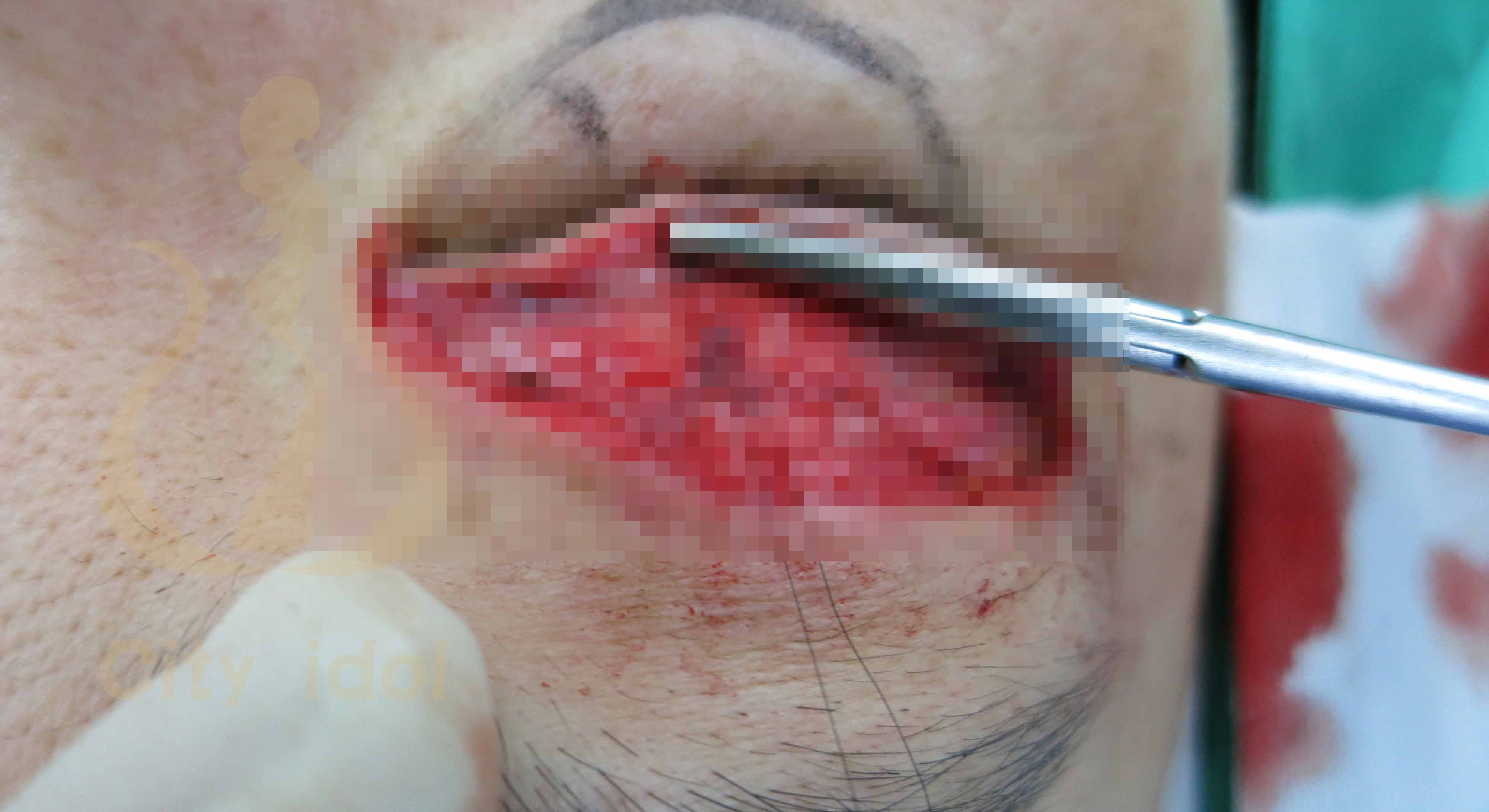 術 中 分 離 出 提 瞼 肌 及 施 行 提 臉 肌 摺 疊 手 術