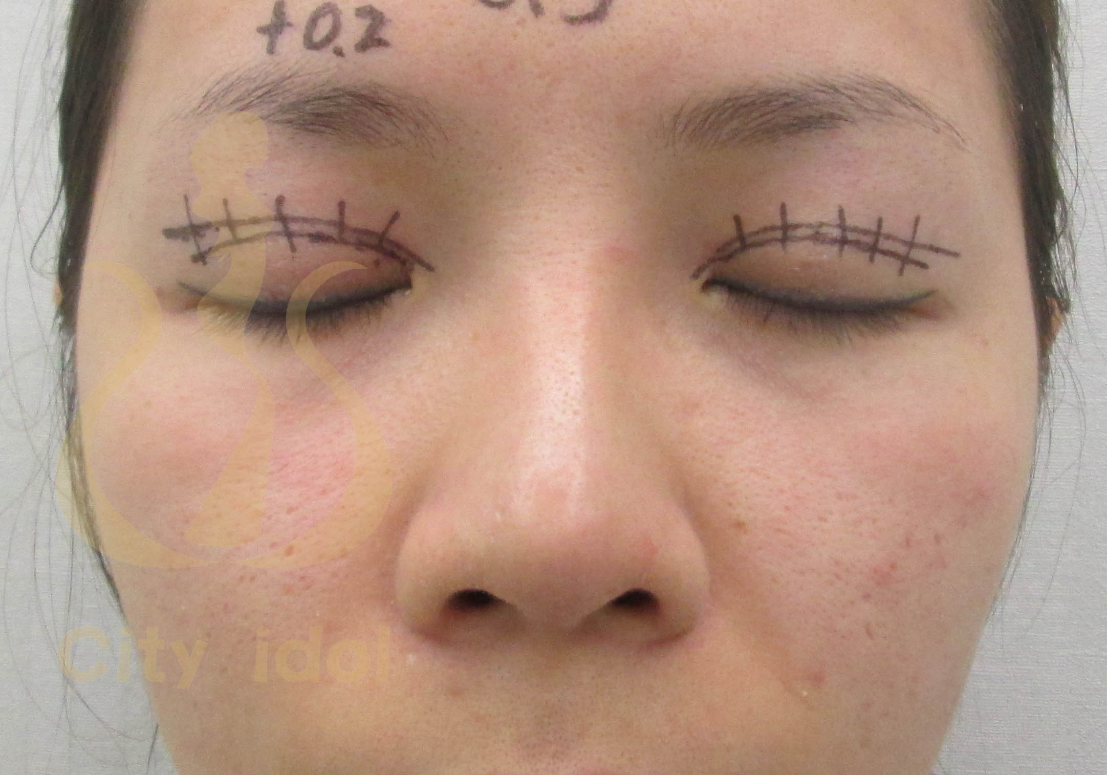 術後6個月施行二次釘書機雙眼皮手術(要求增加眼皮寬度)