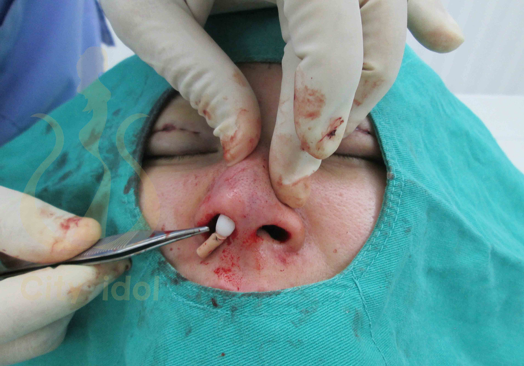 術 中 使 用 L 形 鼻 模 併 加 強 鼻 柱 及 置 入 鼻 模