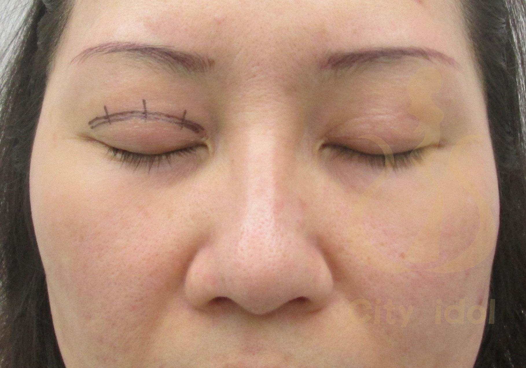 術 後 6 個 月 及 右 側 二 次 釘 書 機 雙 眼 皮 手 術