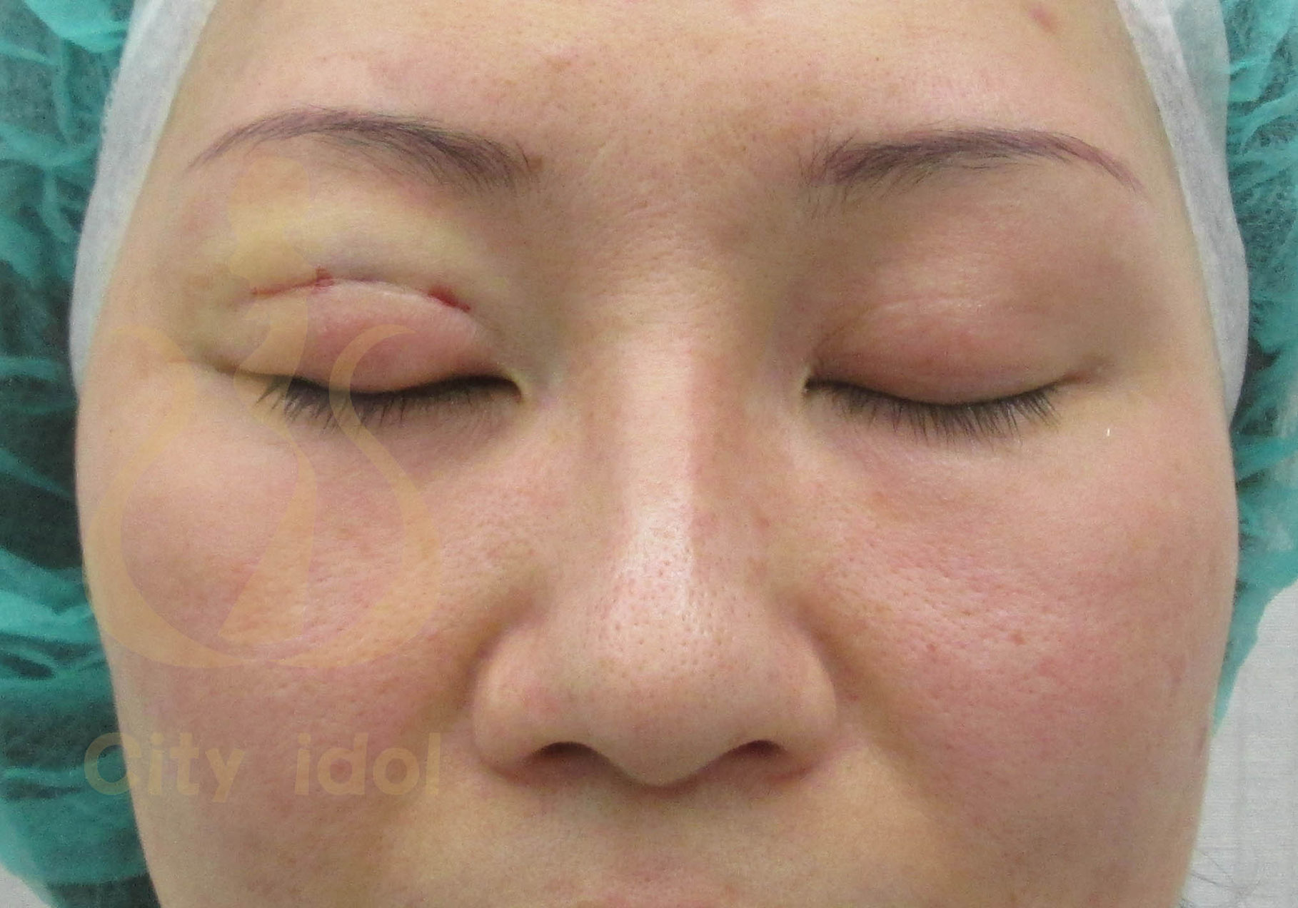 術 後 6 個 月 及 右 側 二 次 釘 書 機 雙 眼 皮 手 術