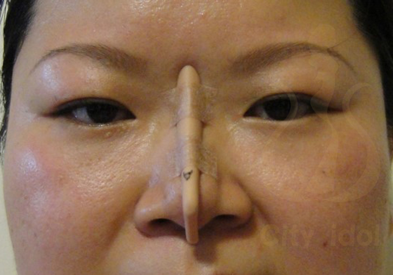 術 前 模 擬 鼻 模 置 入 情 形