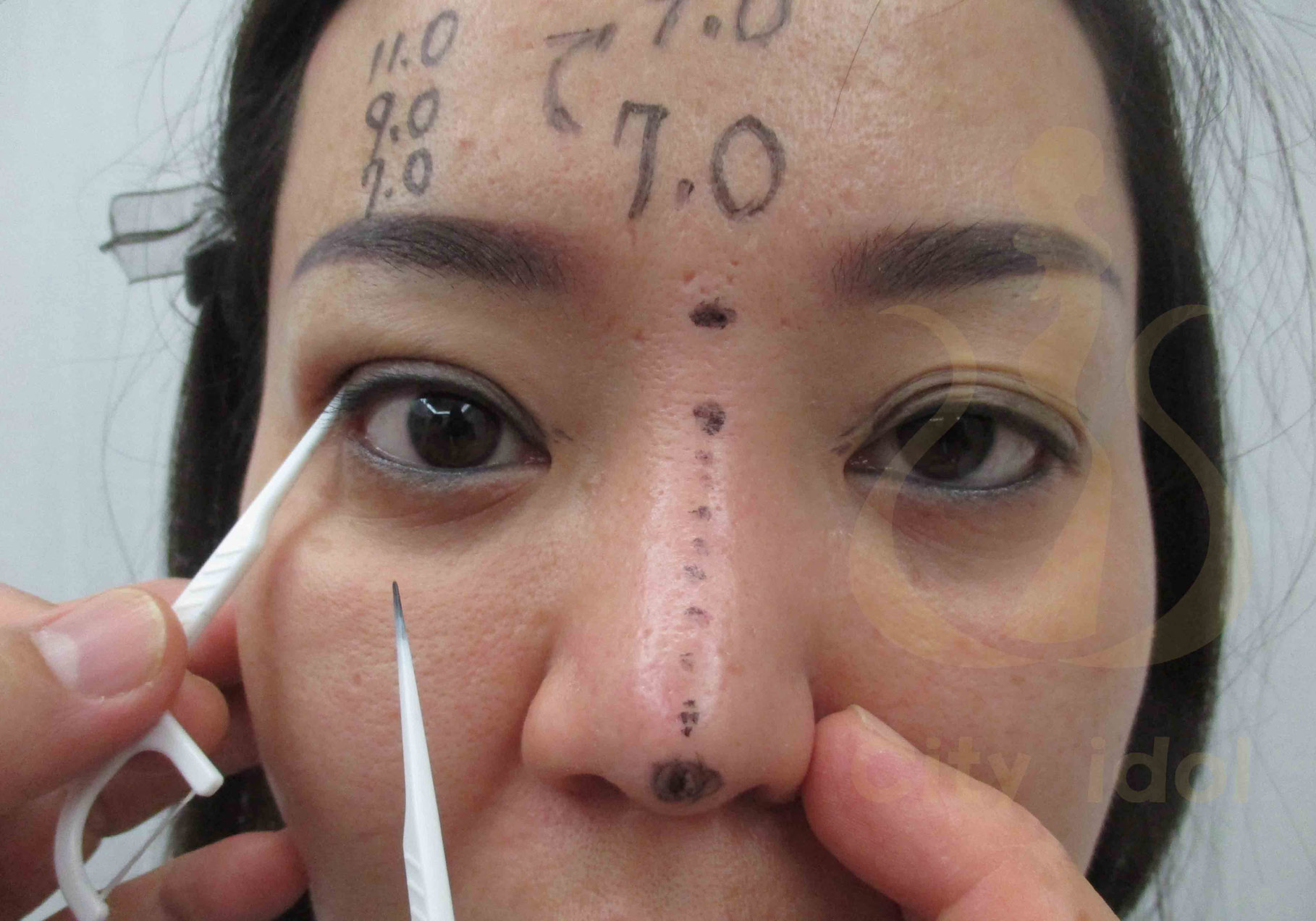 術 前 劃 記 號 ( 隆 鼻 及 牙 纖 模 擬 不 同 寬 度 的 釘 書 機 雙 眼 皮 )
