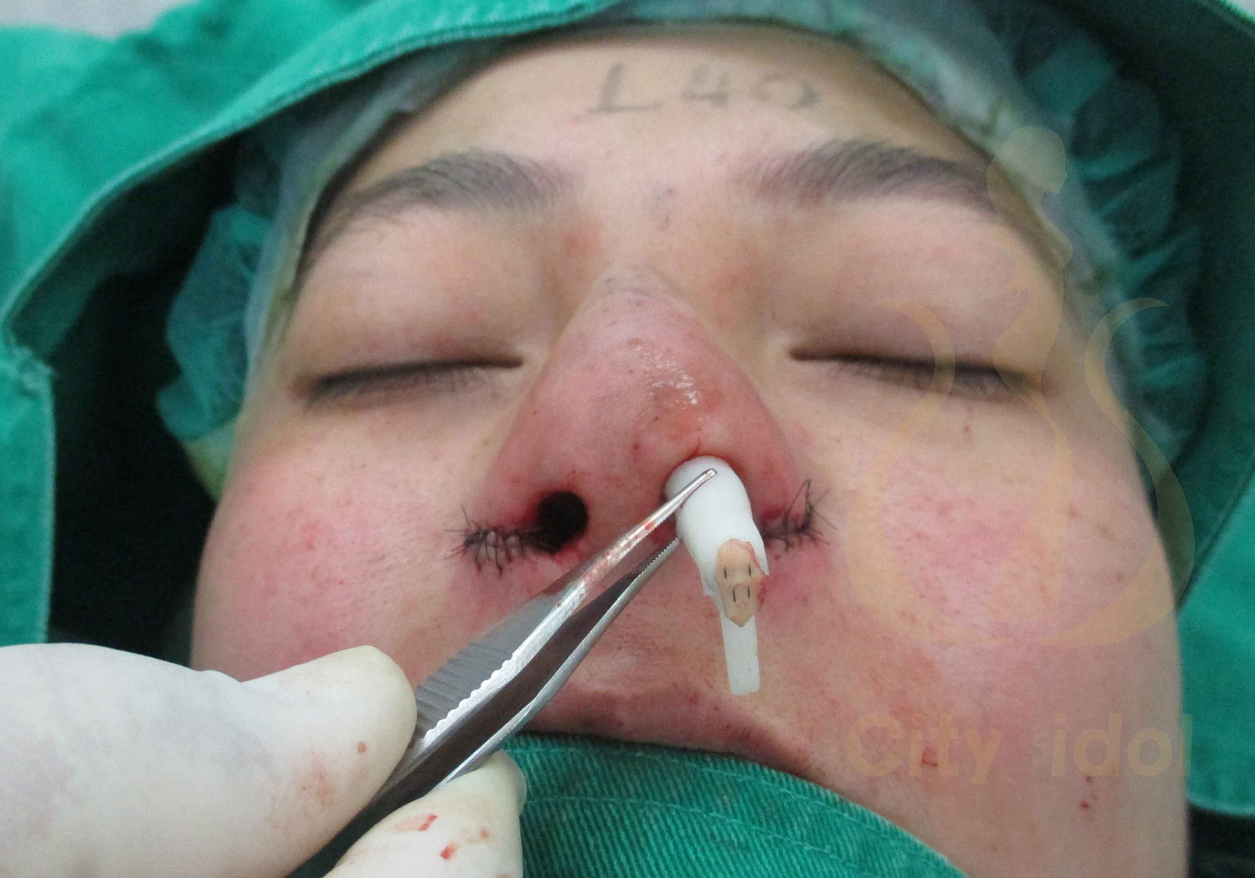 術 中 L 形 鼻 模 挖 凹 洞 修 飾 駝 峰 , 鼻 尖 縫 上 耳 軟 骨 及 置 入 鼻 模