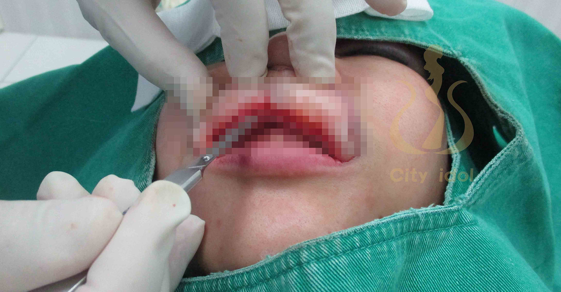 手 術 過 程 及 切 下 的 唇 部 組 織