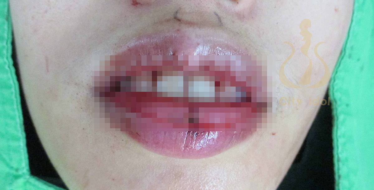 手 術 過 程 及 切 下 的 唇 部 組 織