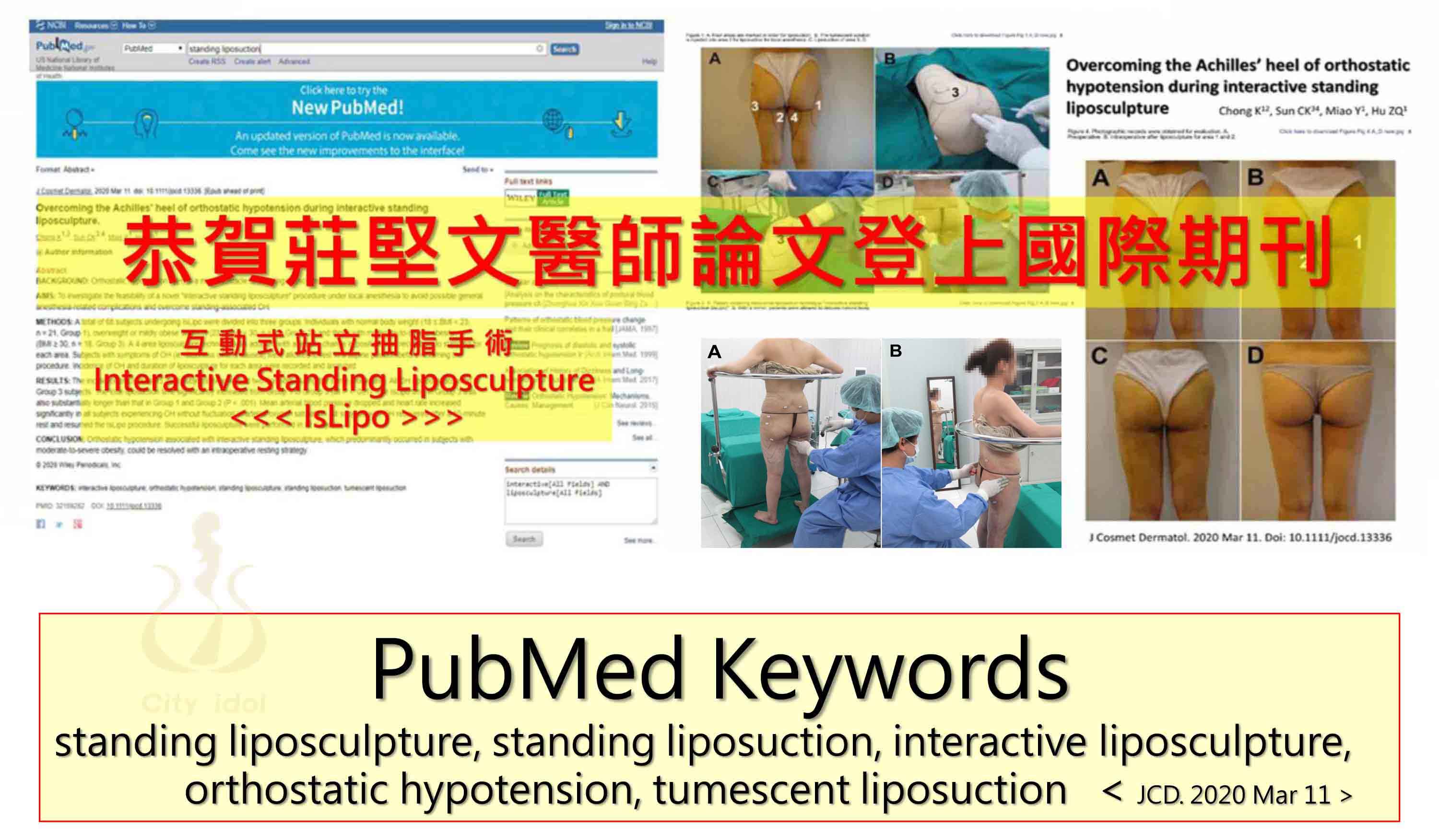 PubMed互動式抽脂手術期刊